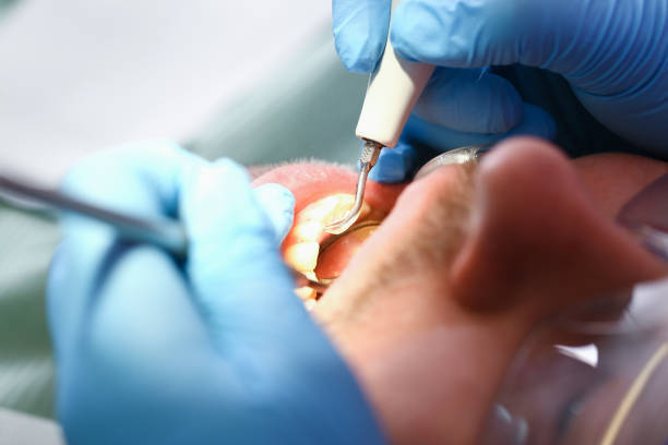 Best Dental Abscess Treatment in Canton, SD