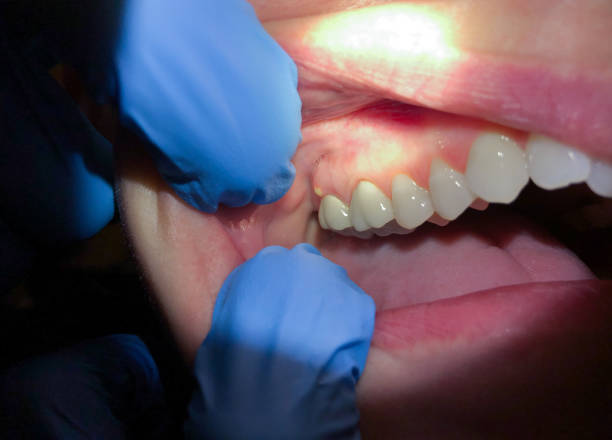 Best Emergency Root Canal Therapy in Canton, SD
